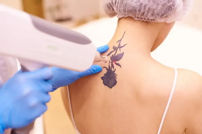 LASER TATTOO REMOVAL by Refresh Aesthetics in ROOSEVELT, UT