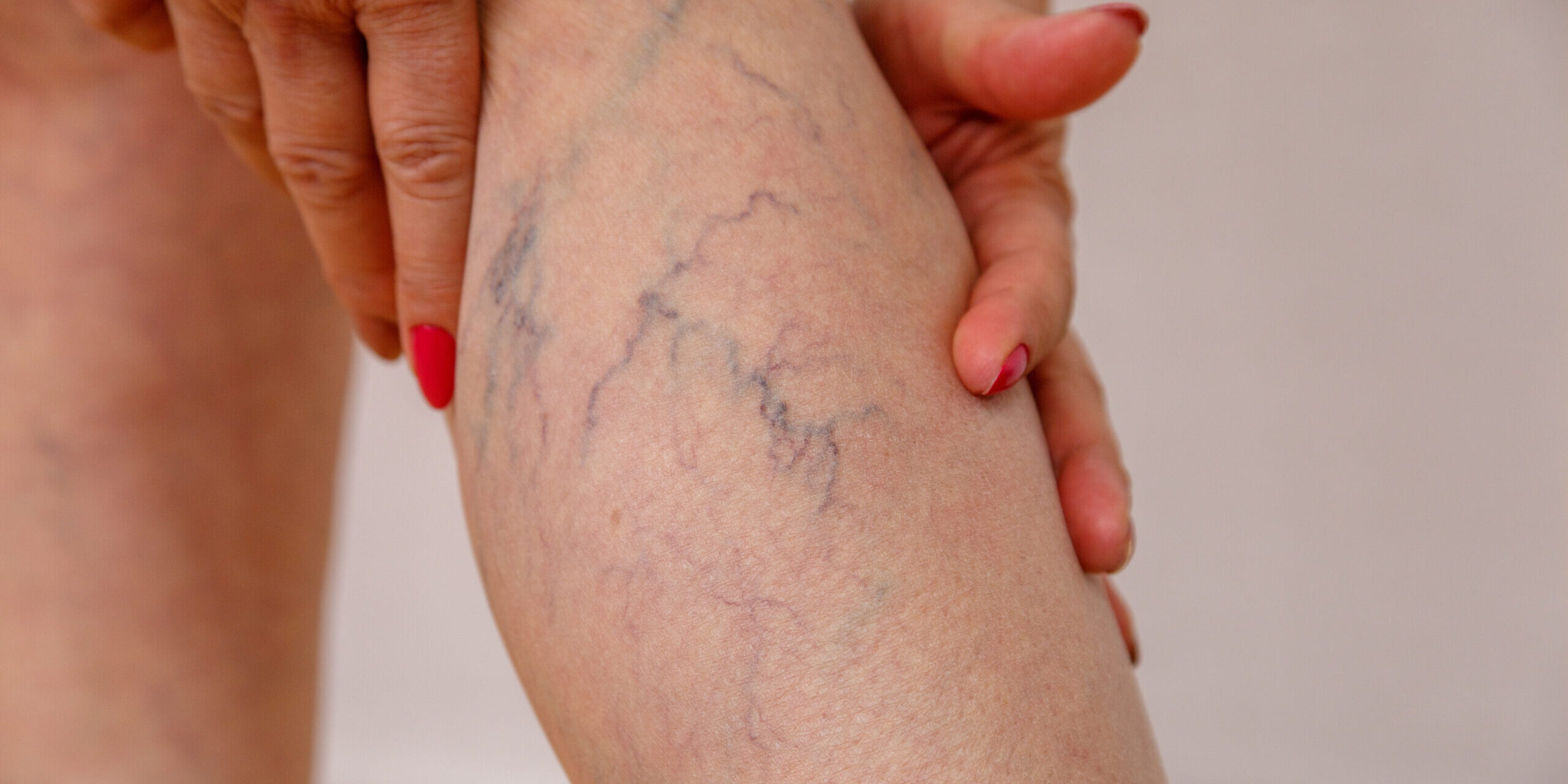 Spider Veins- Refresh Aesthetics