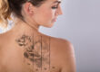 Laser Tattoo Removal