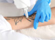 Benefits of Laser Tattoo Removal