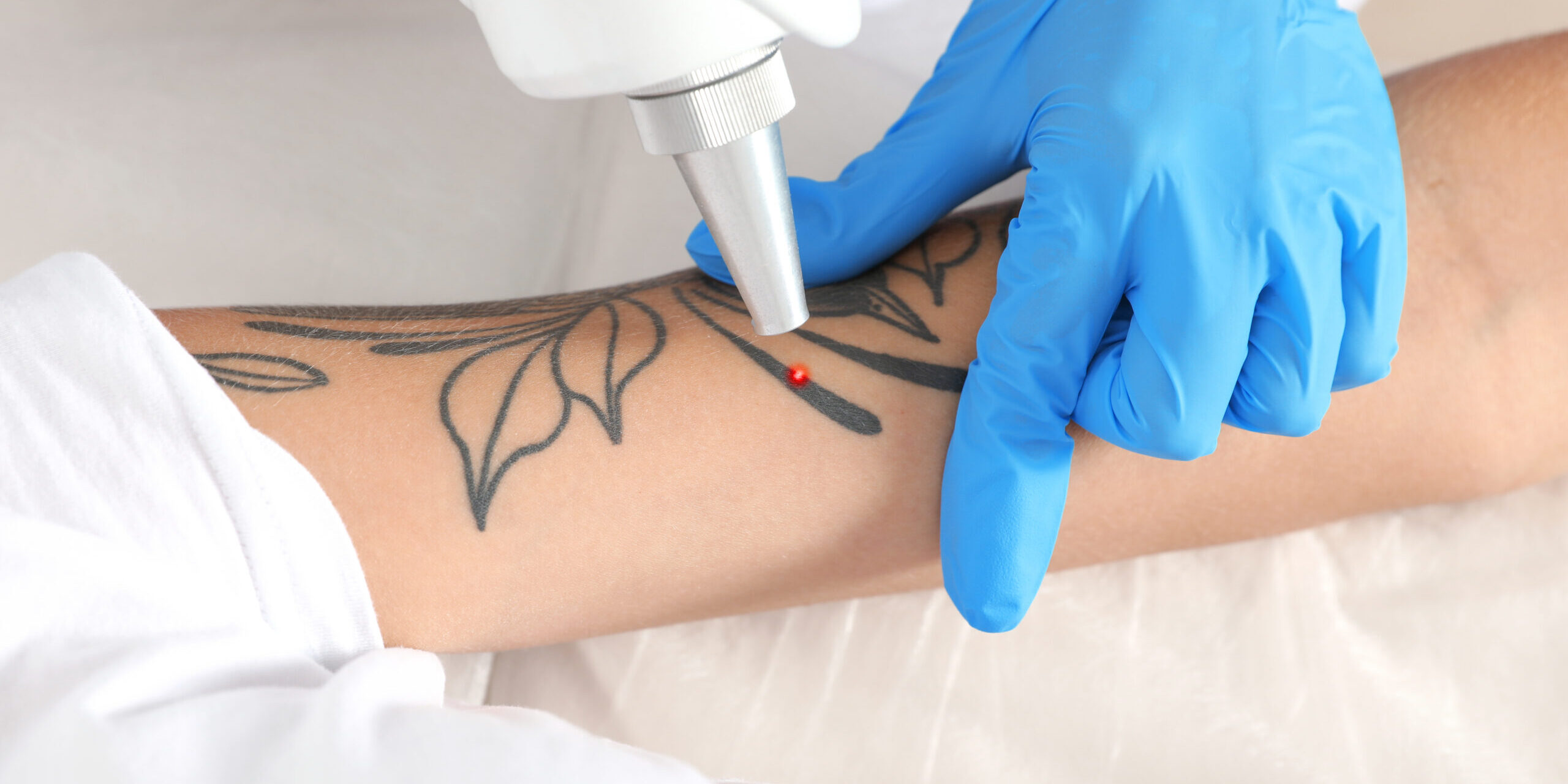 Benefits of Laser Tattoo Removal