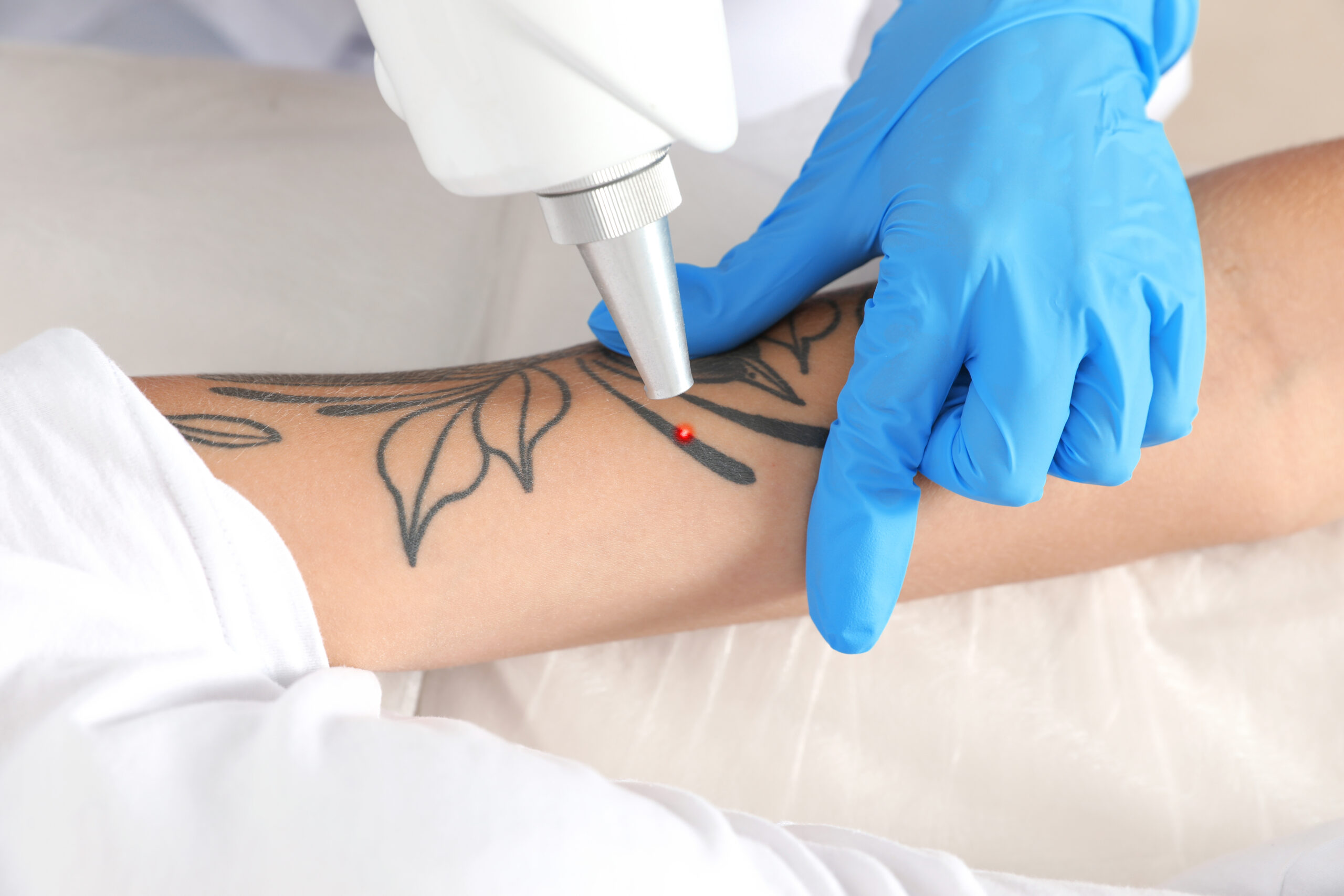 Benefits of Laser Tattoo Removal