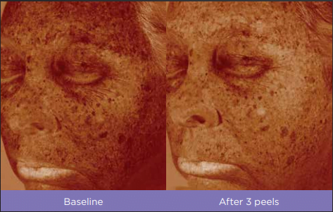 Chemical Peels 5 VITALIZE PEEL® Fitzpatrick skin type: III Treatment in VERNAL ,UT by Refresh Aesthetics