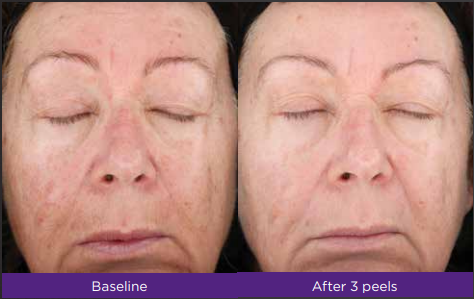 Rejuventize Chemical Peels Fitzpatrick skin type: II Treatment in VERNAL ,UT by Refresh Aesthetics