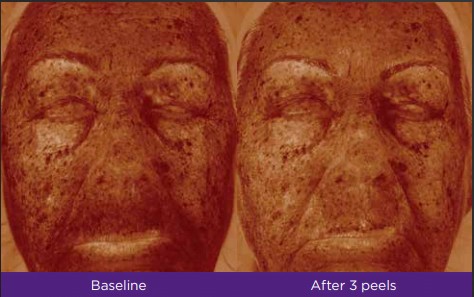 Chemical Peels 8 Fireshot Chemical peel Fitzpatrick skin type: III Treatment in VERNAL ,UT by Refresh Aesthetics