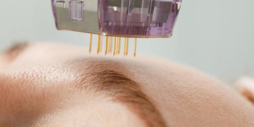 What Is The Optimal Care For Skin After Microneedling?